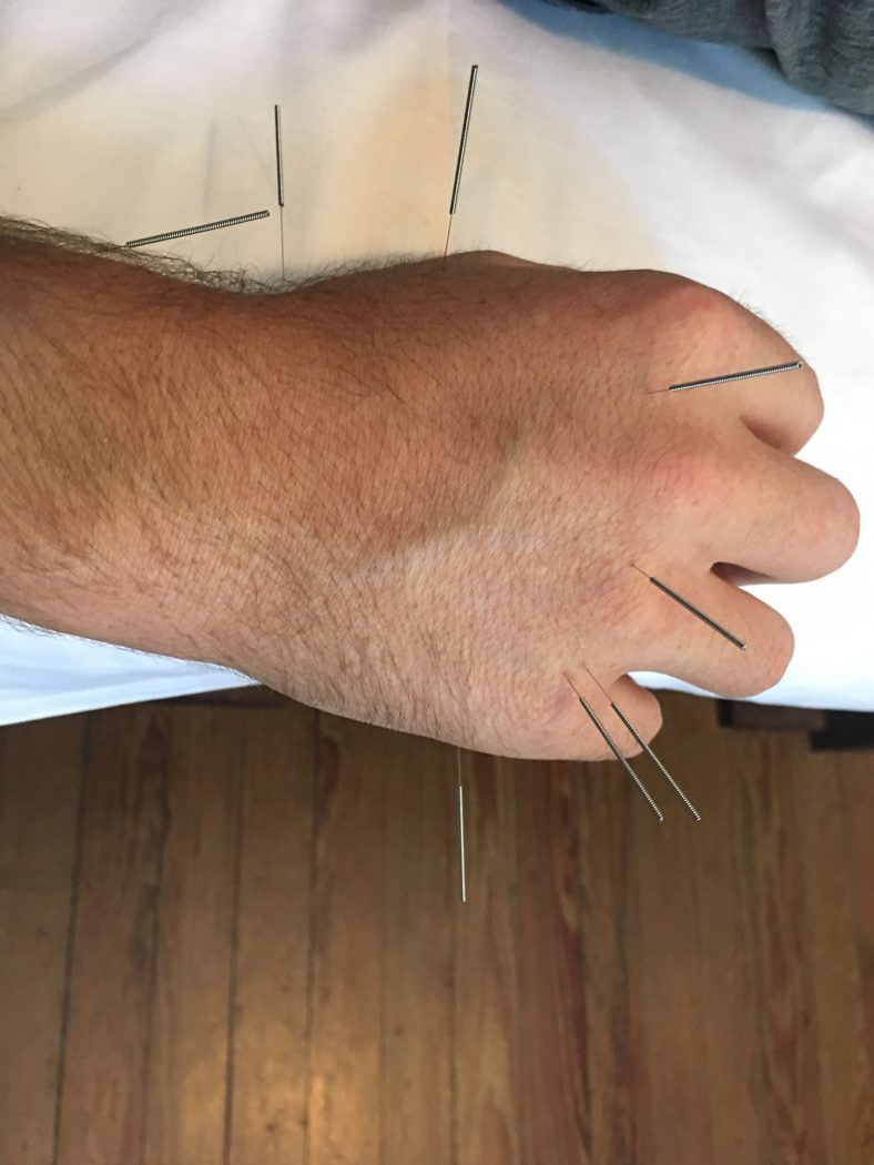 acupuncture buenos aires